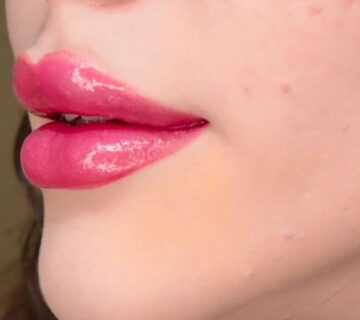 فیلر لب متد روسی