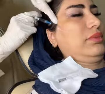 تزریق کات گونه