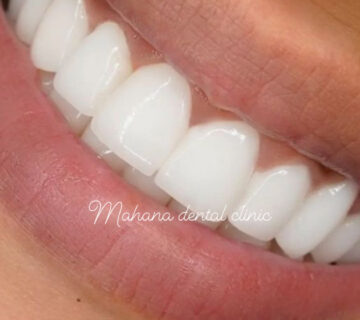 خط لبخند دندان پزشکی ماهانا