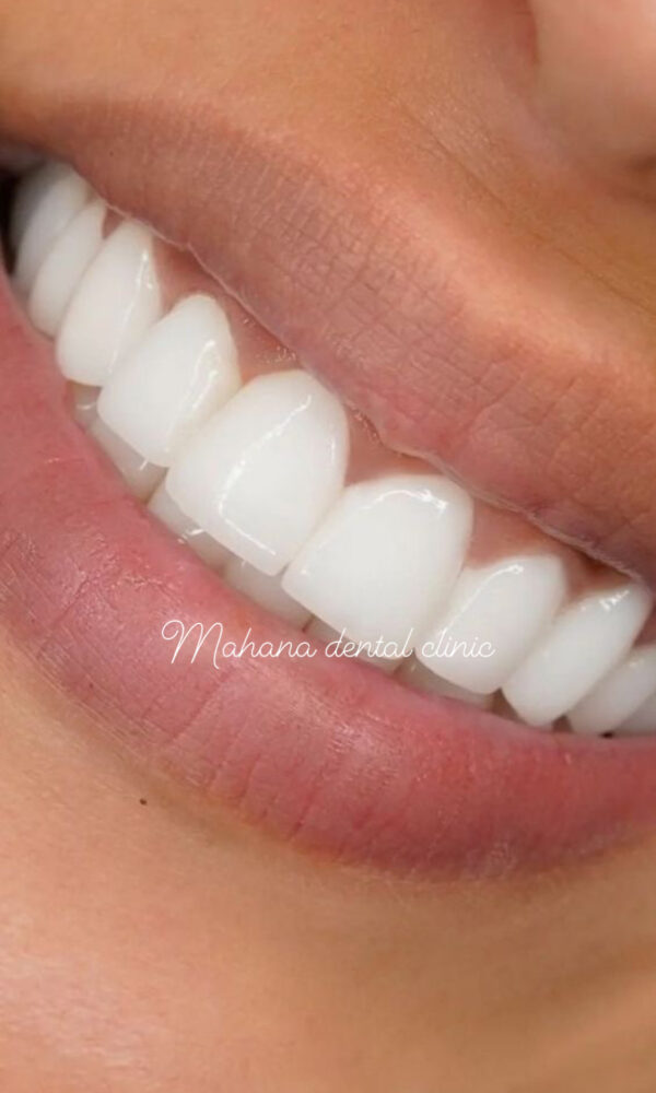 خط لبخند دندان پزشکی ماهانا