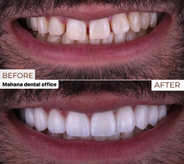 دندانپزشکی ماهانا کامپوزیت