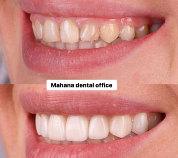 کامپوزیت در دندانپزشکی ماهانا