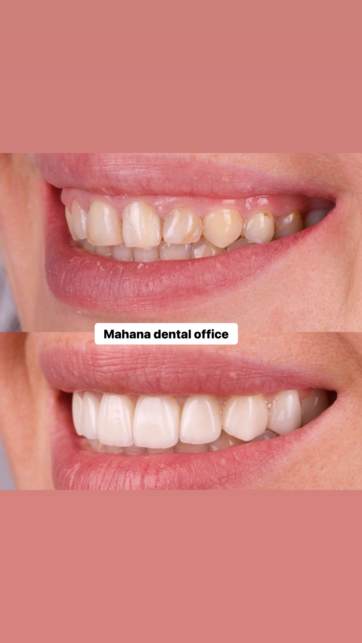 کامپوزیت در دندانپزشکی ماهانا