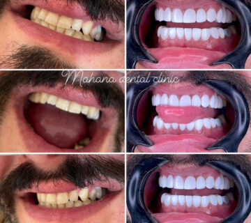 دندانپزشکی ماهانا کامپوزیت و لمینت
