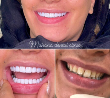 دندانپزشکی ماهانا کامپوزیت و لمینت