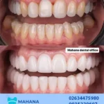 سوالات متدول در مورد کامپوزیت دندان چیست؟