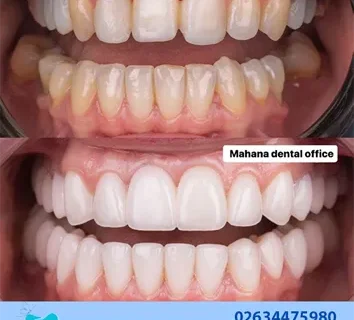 سوالات متدول در مورد کامپوزیت دندان چیست؟