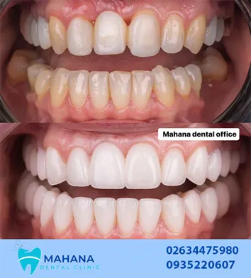 سوالات متدول در مورد کامپوزیت دندان چیست؟