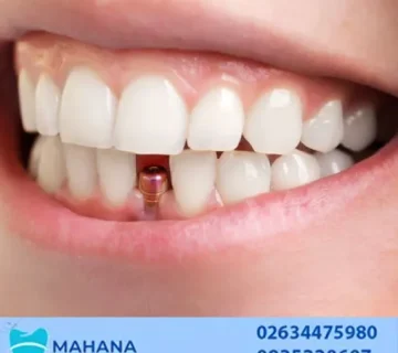 ایمپلنت دندان در خرمدشت کرج