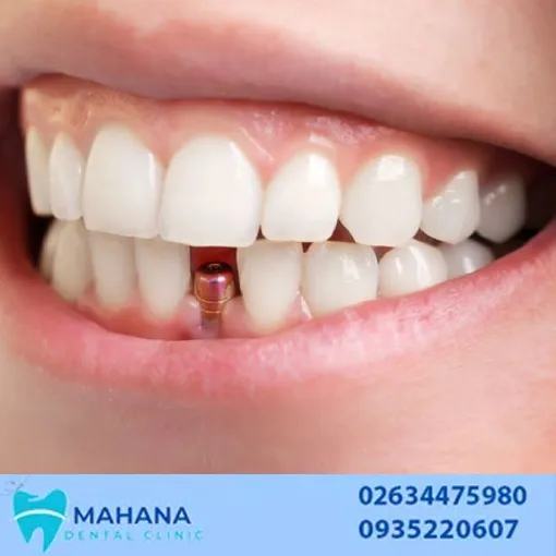 ایمپلنت دندان در خرمدشت کرج