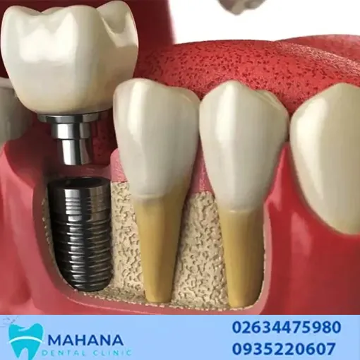 کارهایی که قبل از ایمپلنت دندان باید انجام دهید؟