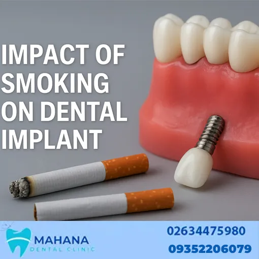 تاثیر سیگار بر ایمپلنت دندان