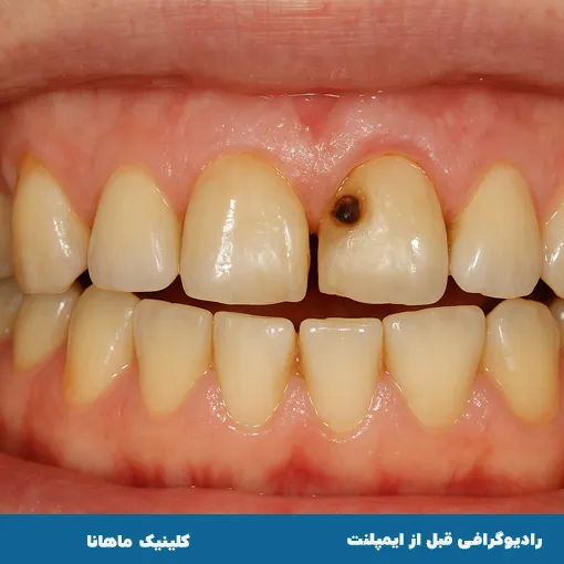 تصویربرداری قبل از ایمپلنت 