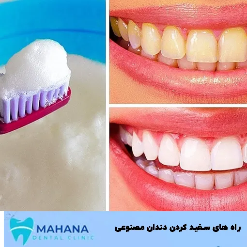 را های سفید کردن دندان مصنوعی