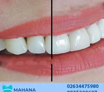 لمینت یا کامپوزیت کدام یک بهتر است؟