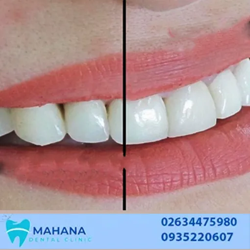 لمینت یا کامپوزیت کدام یک بهتر است؟