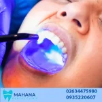 مواد تشکیل دهنده کامپوزیت دندان کدام است؟