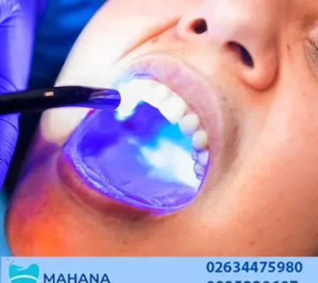 مواد تشکیل دهنده کامپوزیت دندان کدام است؟