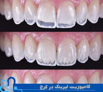 کامپوزیت لیرینگ در کرج