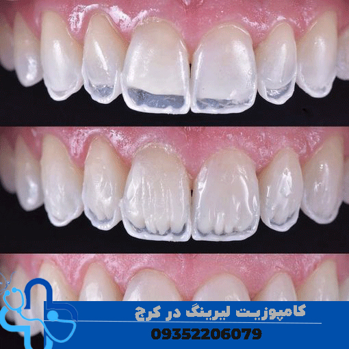 کامپوزیت لیرینگ در کرج