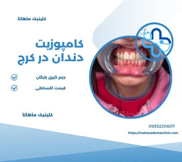 کامپوزیت دندان در کرج