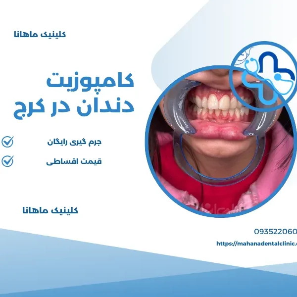 تصویر راهنمای کامپوزیت دندان در کلینیک ماهانا در کرج