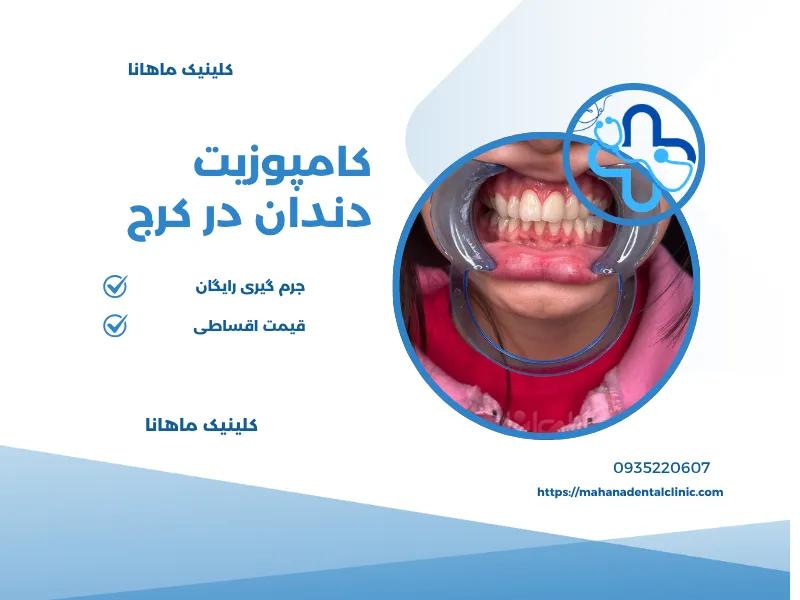 تصویر راهنمای کامپوزیت دندان در کلینیک ماهانا در کرج