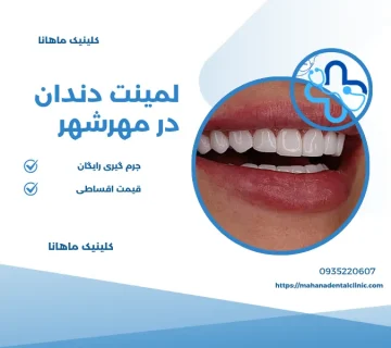 لمینت دندان در مهرشهر کرج