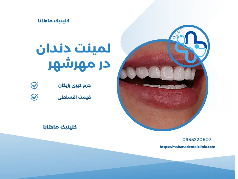لمینت دندان در مهرشهر کرج