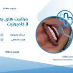مراقبت های بعد از کامپوزیت دندان