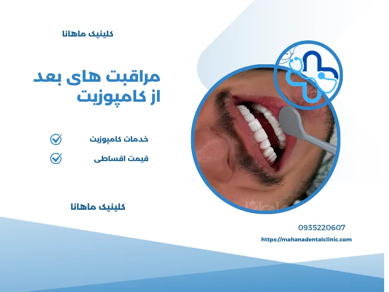 مراقبت های بعد از کامپوزیت دندان