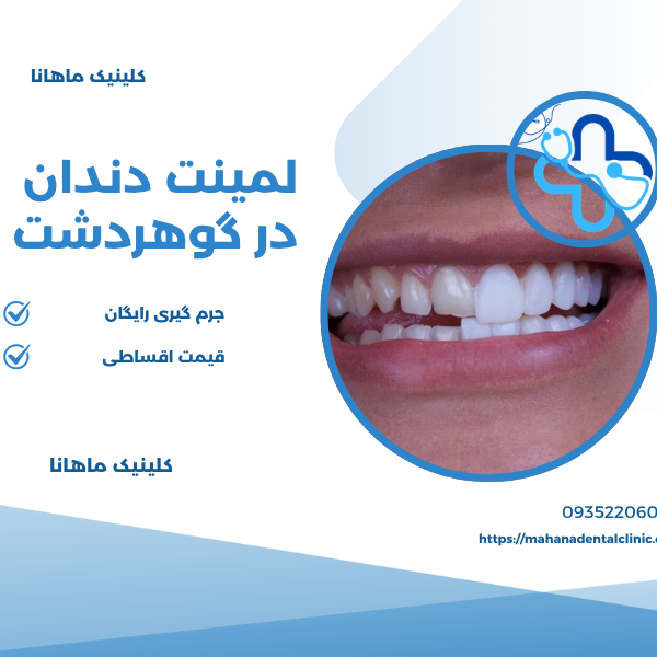 لمینت دندان در گوهردشت