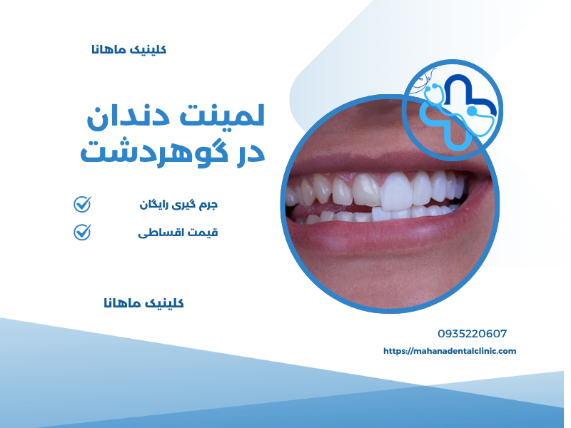 لمینت دندان در گوهردشت