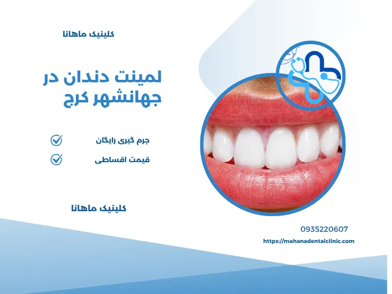لمینت دندان در جهانشهر