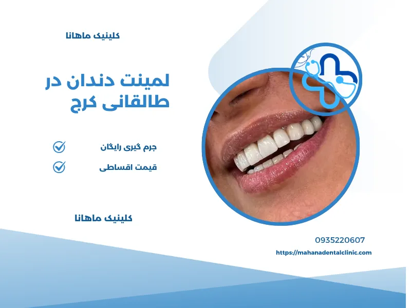 لمینت دندان در طالقانی کرج