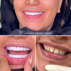 دندانپزشکی ماهانا کامپوزیت و لمینت