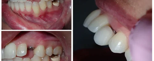 ایمپلنت دندان در کیانمهر کرج ایمپلنت دندان در کیانمهر کرج