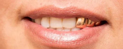 روکش دندان طلا 1 روکش دندان طلا 1