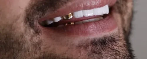 روکش دندان طلا 4 روکش دندان طلا 4