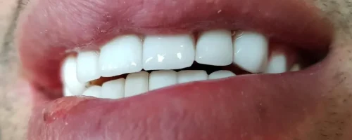 لمینت دندان 2 لمینت دندان 2