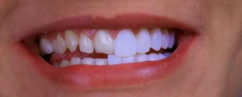 لمینت دندان 2 لمینت دندان 2