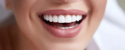 لمینت دندان 3 لمینت دندان 3