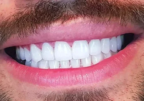 لمینت دندان 3 لمینت دندان 3