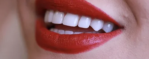 لمینت دندان 6 لمینت دندان 6