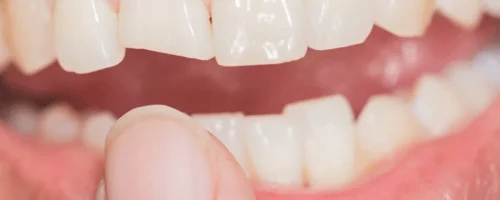 لمینت دندان 6 لمینت دندان 6