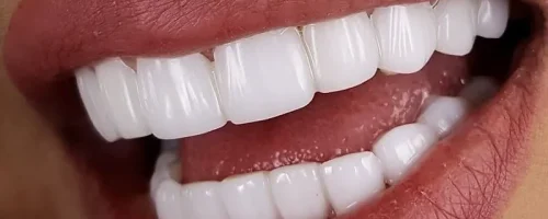 کامپوزیت 1 کامپوزیت 1